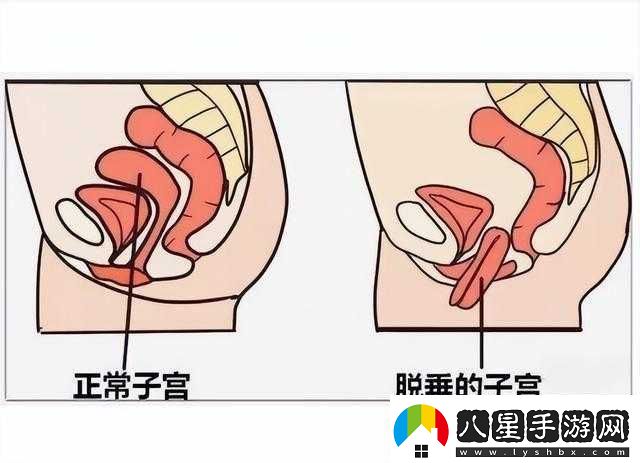 女性得陰挺病是怎么回事