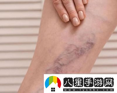 日系裸妝風(fēng)格與女士靜脈曲張成因詳解