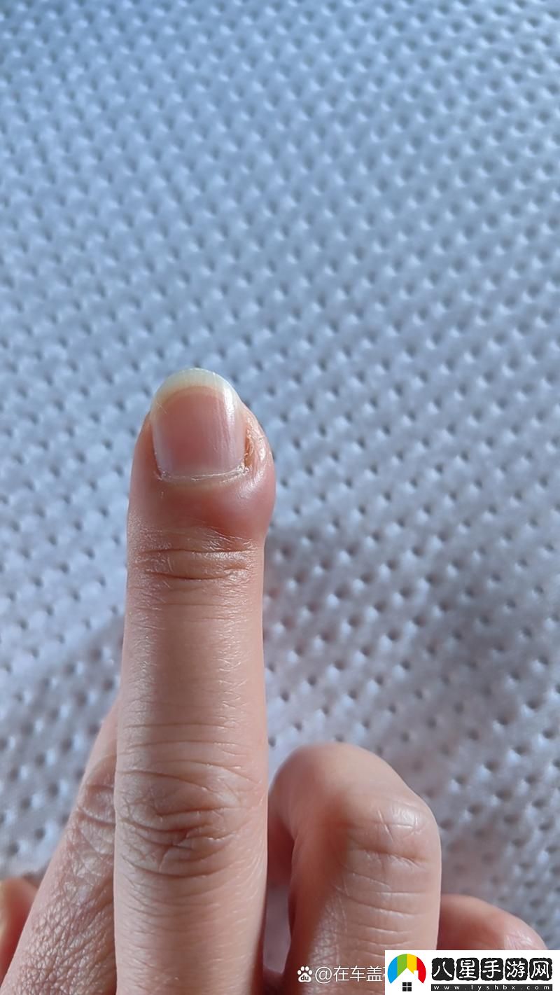 粗大的蘑菇頭刮得又紅又腫怎么辦上線